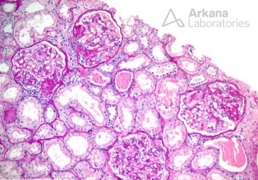 Enlarged Glomeruli with Segmental Sclerosis NOS on PAS_1