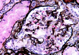 Enlarged Glomerulus with a FSGS Tip Lesion on Silver Stain