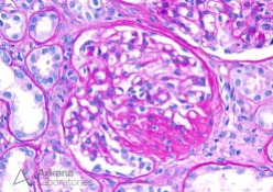 Enlarged Glomerulus with FSGS NOS on PAS