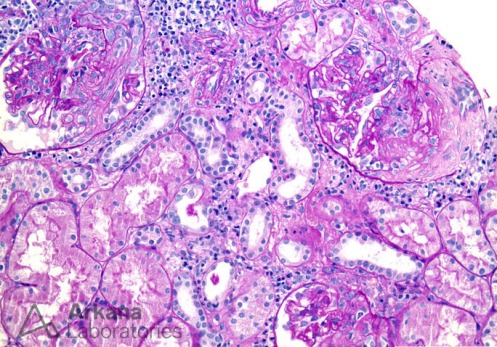 Fibrocellular Crescent Formation and Interstitial Inflammation in Lupus Nephritis on PAS
