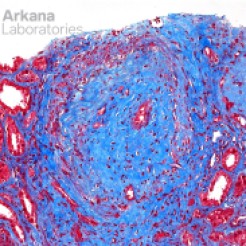 Fibrointimal Vascular Proliferation from Vascular Damagein ANCA Trichrome