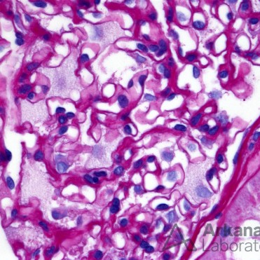Foamy Podocytes in Fabry Disease