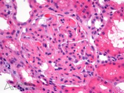 Glomerular Fibrin Thrombi in a Patient with Preeclampsia on H&E