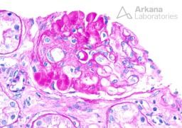 Glomerulus with Perihilar FSGS and Hyalinosis on PAS