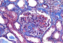 Glomerulus with Perihilar FSGS and Hyalinosis on Trichr