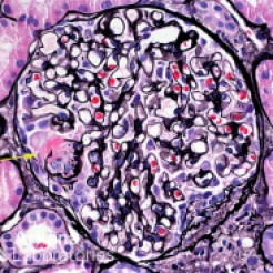 Glomerulus with Segmental Necrotizing Lesion