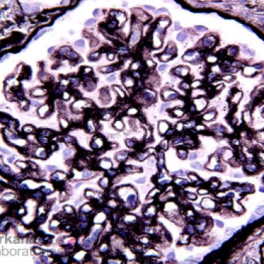 Hole and Spike Formation in Membranous Glomerulopathy on Silver Stain_2