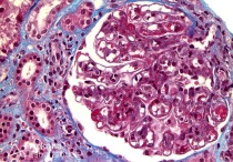 Wire Loop Formation and Hyaline Thrombi in Lupus Nephritis on Trichrome