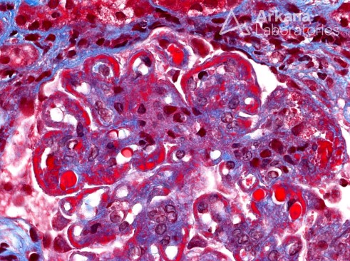 Wire Loop Formation in Lupus Nephritis on Trichrome Stain